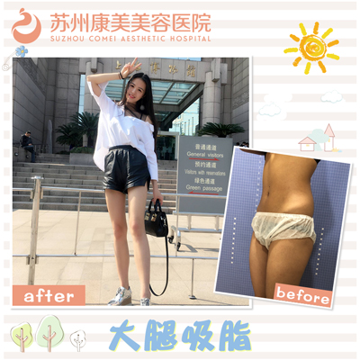 劉道功大腿吸脂案例