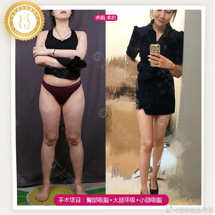 何斌醫生大腿環吸案例