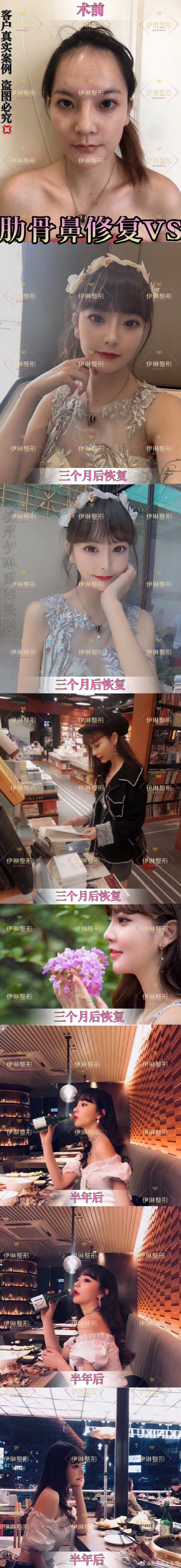 毛琪鼻修復(fù)案例