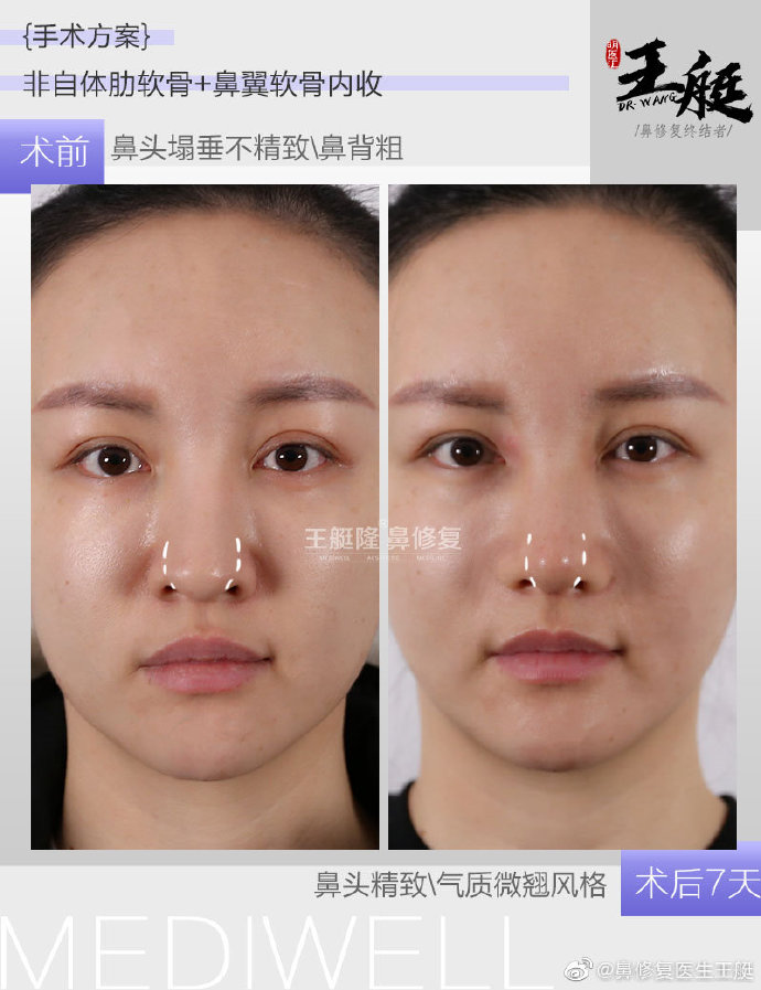 王艇鼻修復(fù)案例