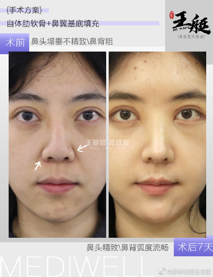 王艇鼻修復(fù)案例