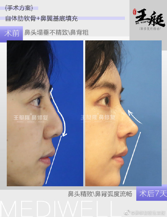 王艇鼻修復(fù)案例