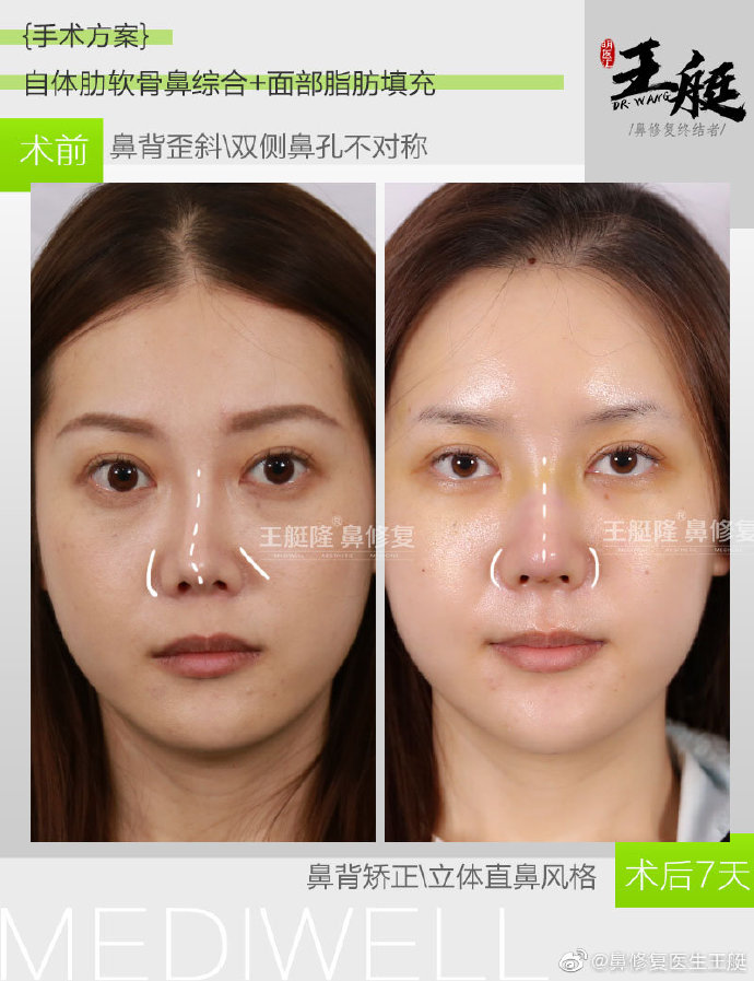 王艇鼻修復(fù)案例