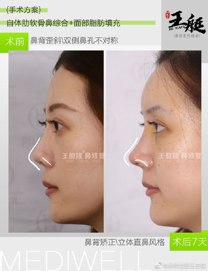 王艇鼻修復(fù)案例