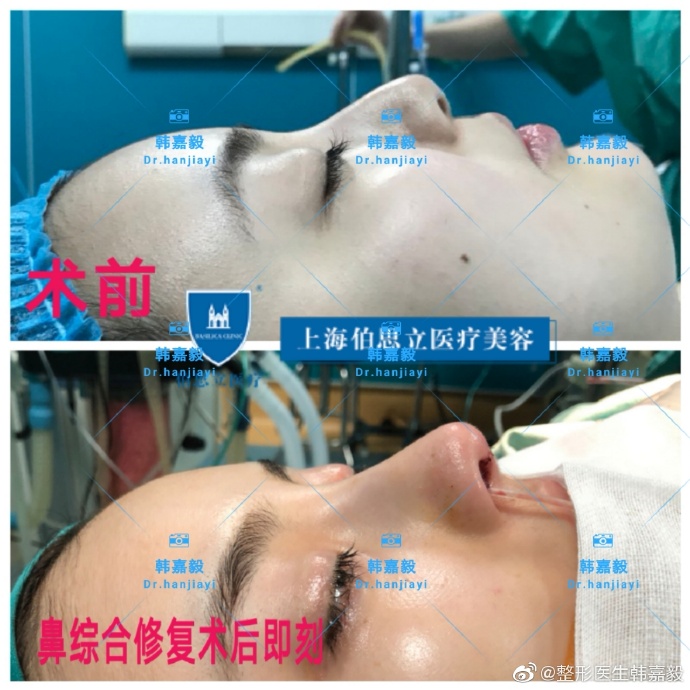 韓嘉毅鼻修復案例