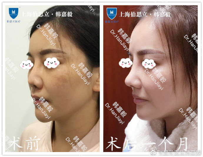 韓嘉毅鼻修復案例
