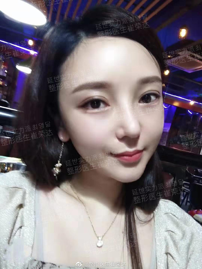 崔榮達下頜角顴骨案例