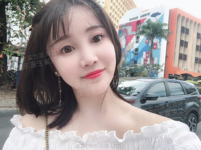 崔榮達面部輪廓案例