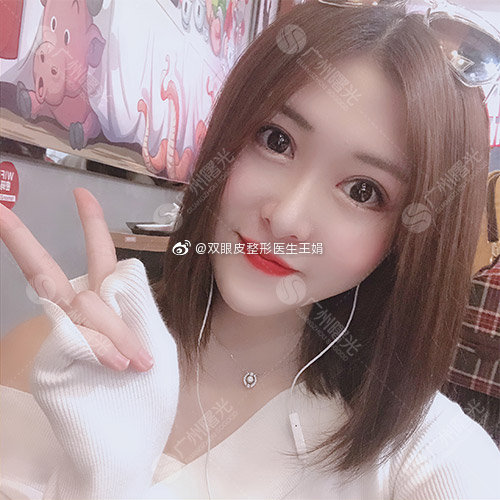 雙眼皮