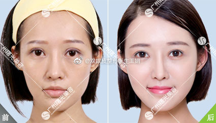 雙眼皮修復案例