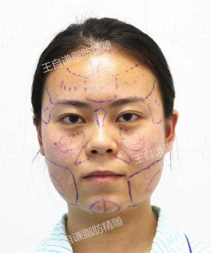 王自謙面部精雕案例