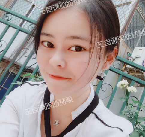 王自謙面部精雕案例