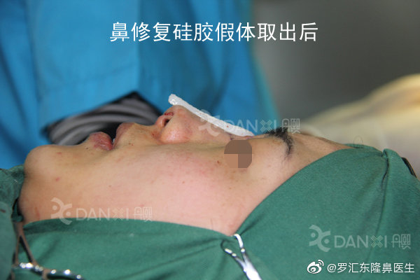 羅匯東鼻修復(fù)案例