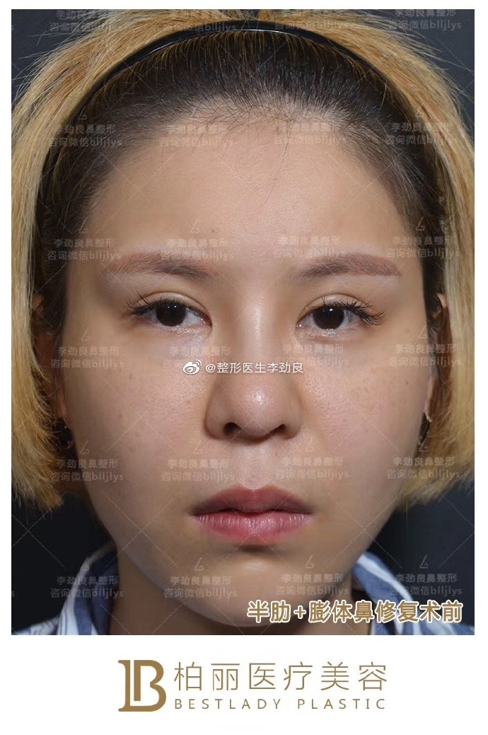 李勁良鼻修復(fù)案例
