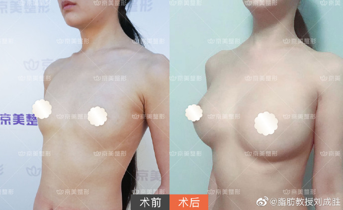 劉成勝脂肪豐胸案例