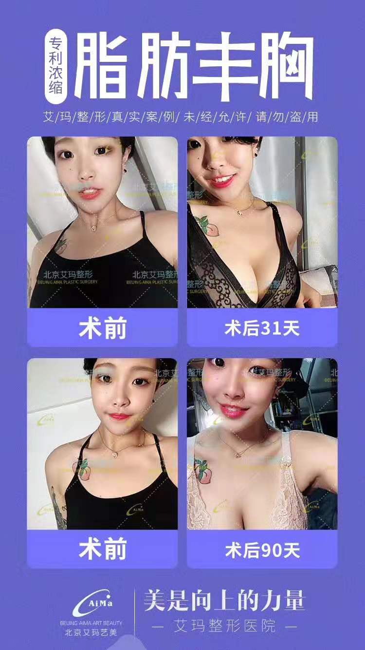 韋元強脂肪豐胸案例