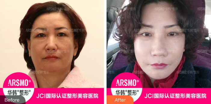 柳民熙面部除皺案例