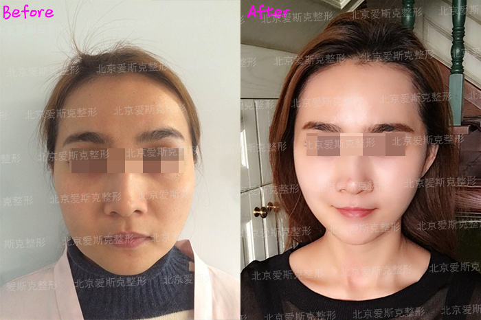 孫瑋駿面部提升案例