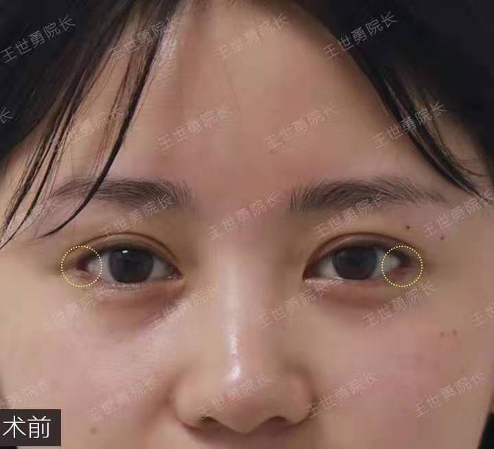 王世勇內眼角修復案例
