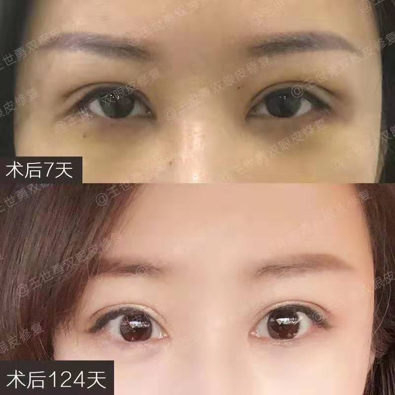 王世勇雙眼皮內眼角修復案例