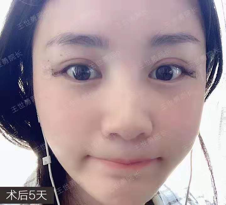 王世勇外眼角修復案例