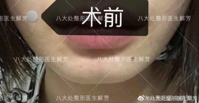解芳下頜角整形案例