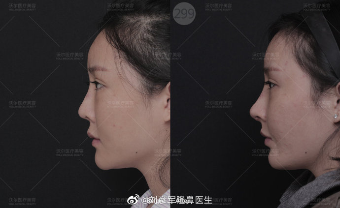 劉彥軍隆鼻案例