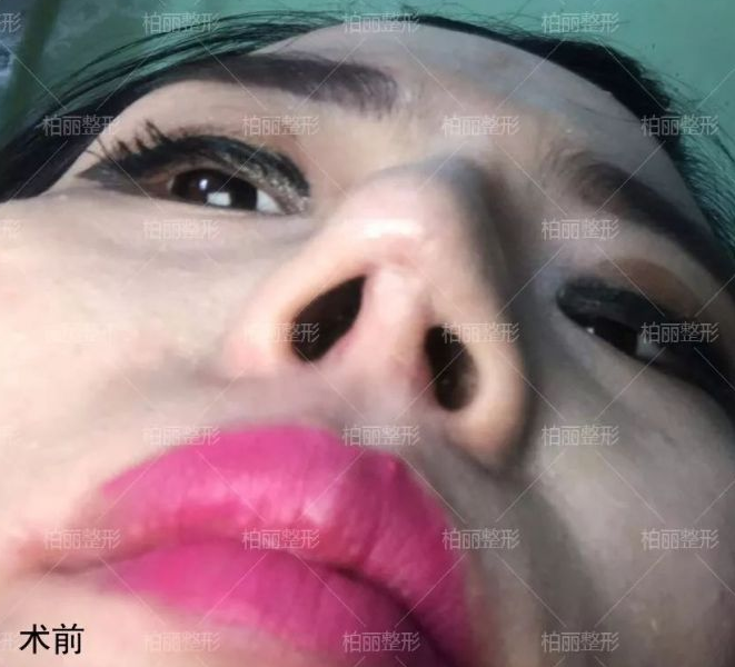 高難度鼻修復案例