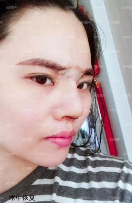 高難度鼻修復案例