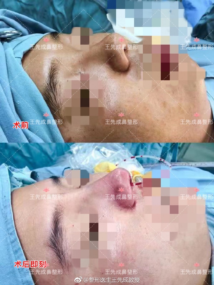 王先成高難度鼻修復案例
