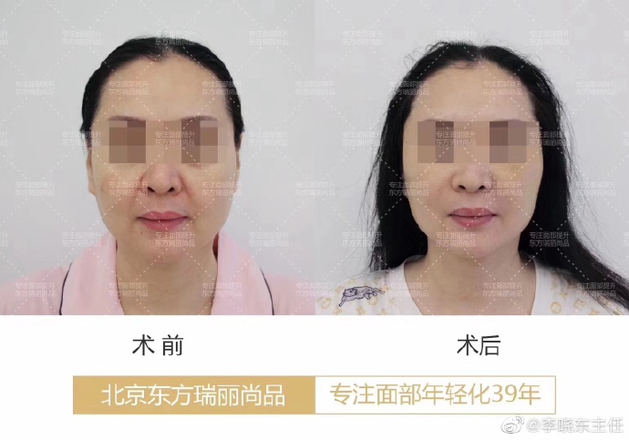 李曉東面部提升案例