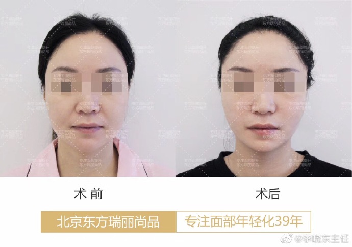 李曉東面部提升案例