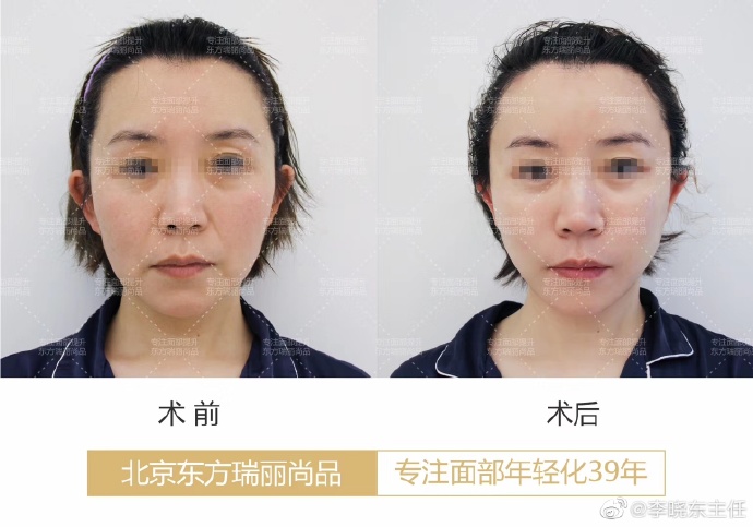 李曉東面部提升案例