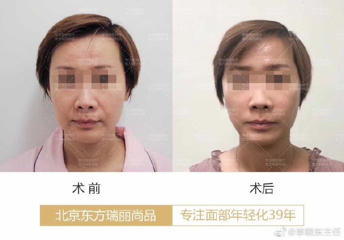 李曉東面部提升案例
