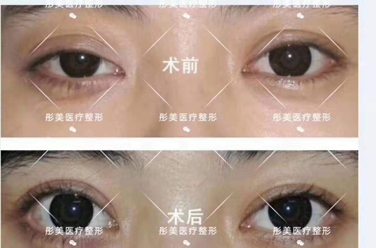 劉風卓雙眼皮修復案例