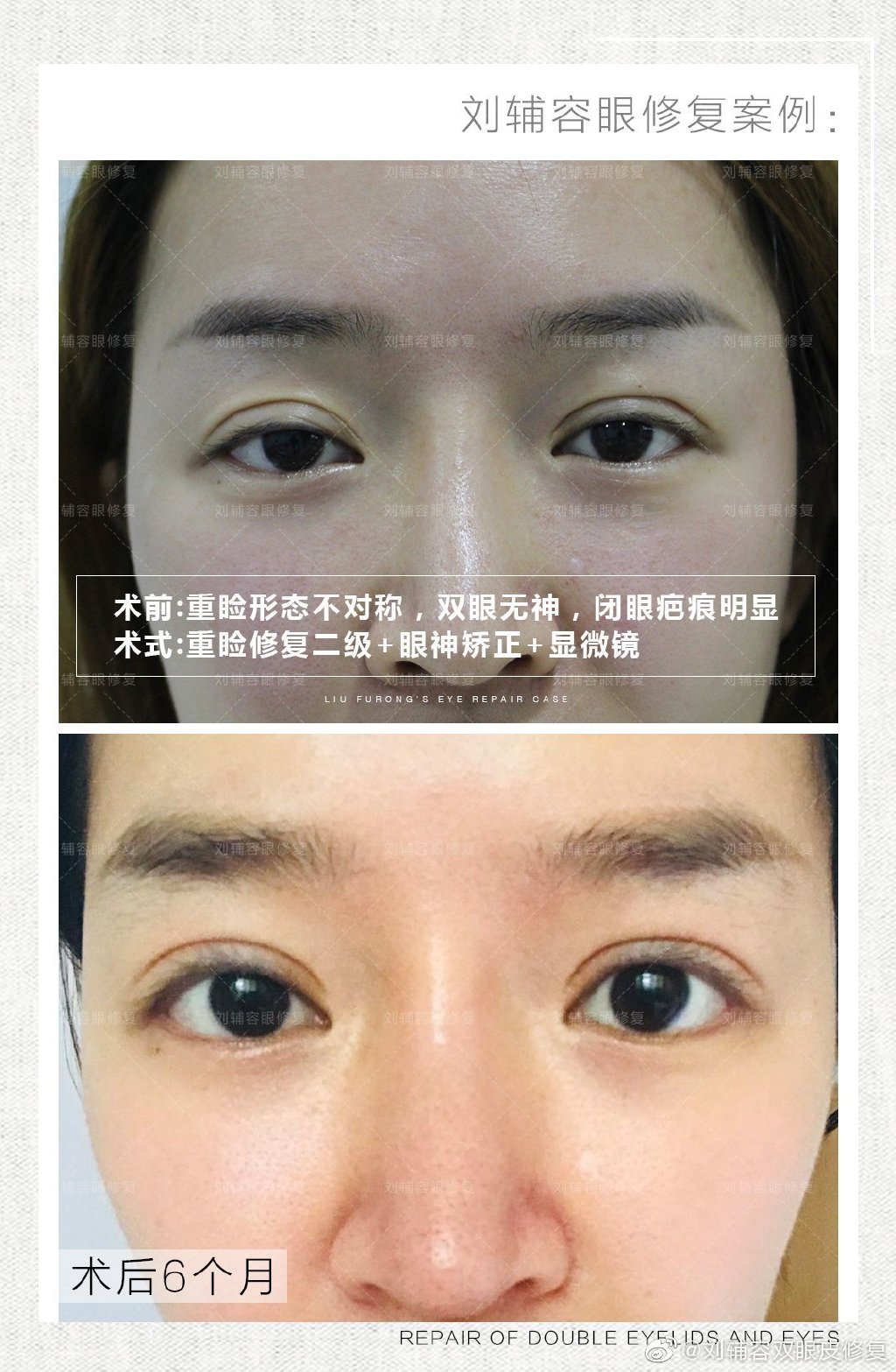 劉輔容雙眼皮修復案例