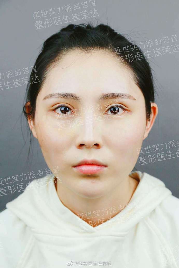 崔榮達磨骨案例