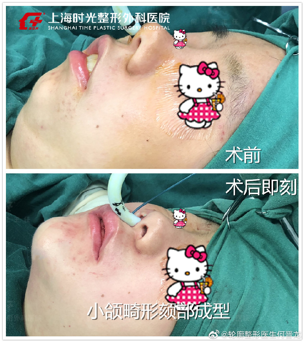 何晉龍頜面案例