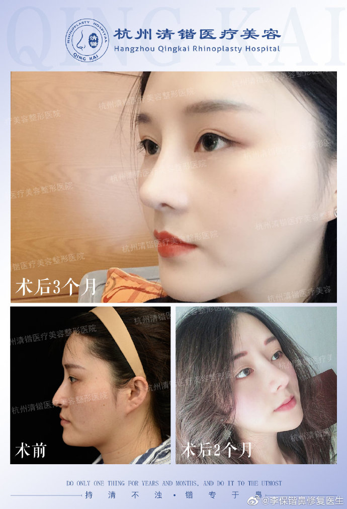 李保鍇鼻修復案例