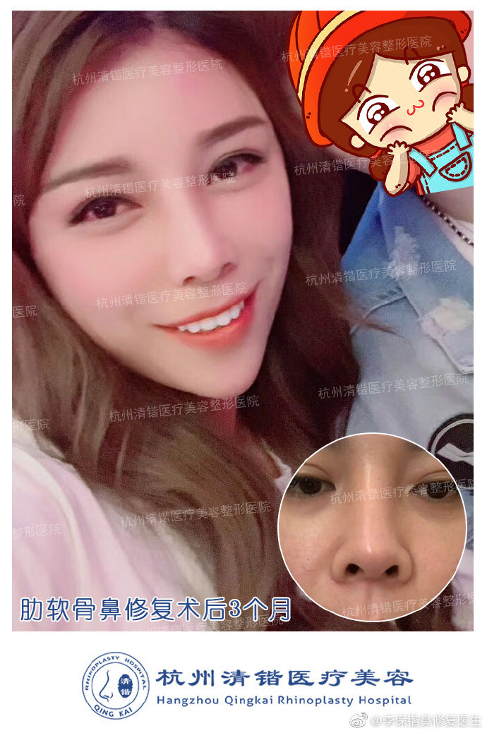 李保鍇鼻修復案例
