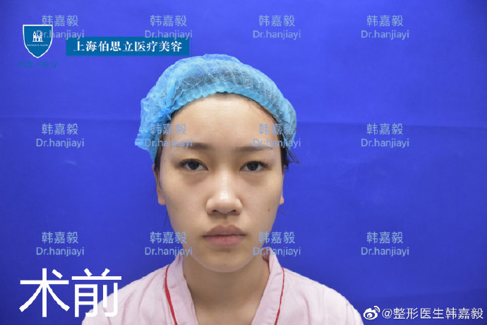 韓嘉毅鼻整形案例