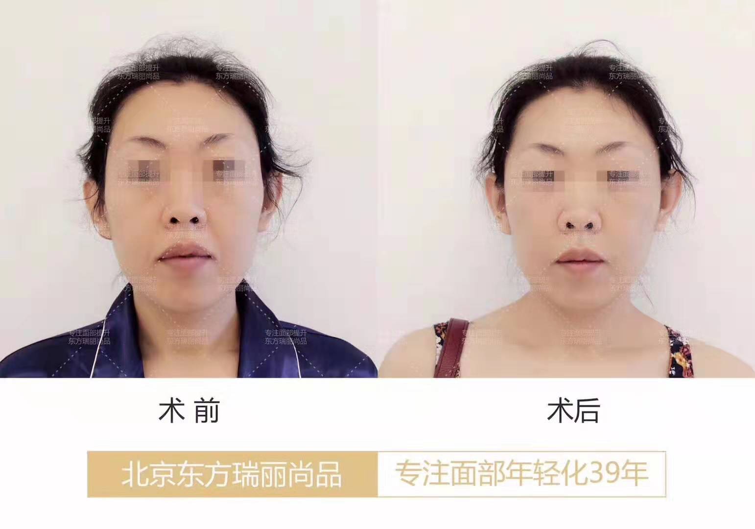 李曉東面部提升案例
