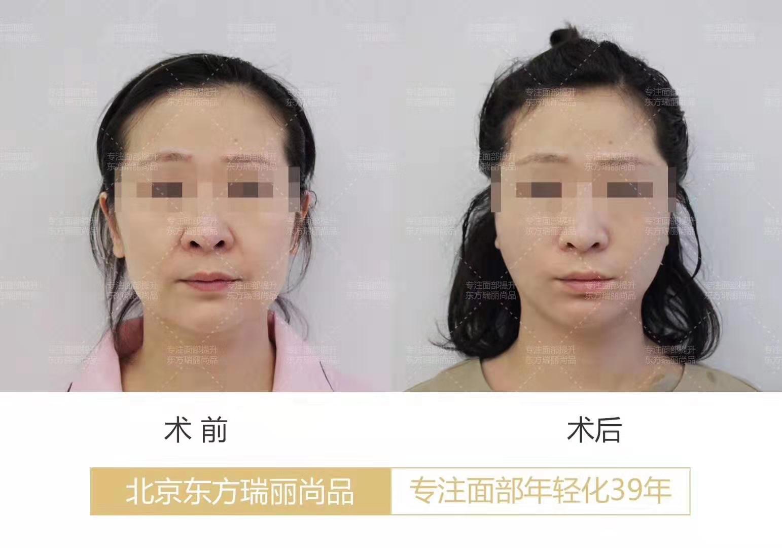 李曉東面部提升案例