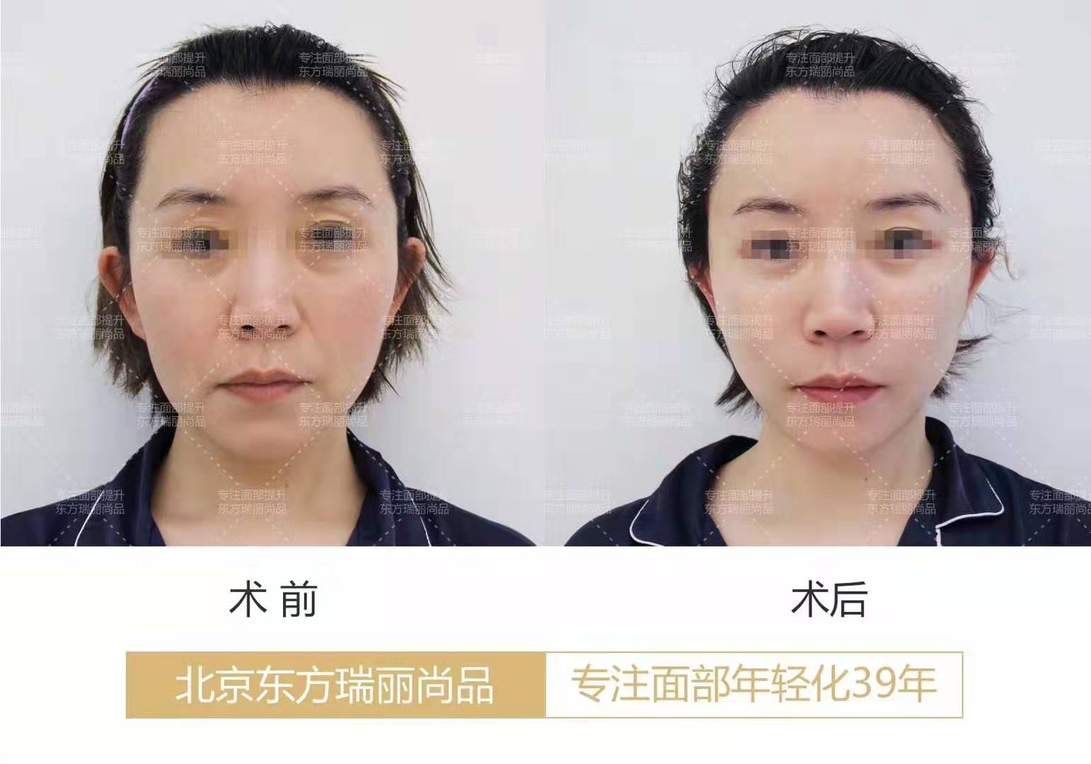 李曉東面部提升案例