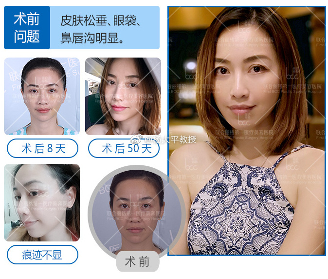 楊大平面部提升案例