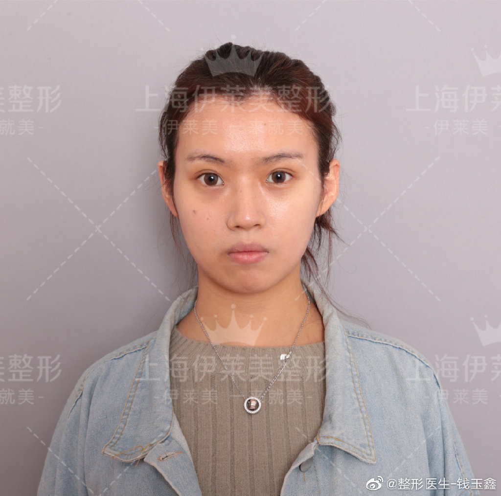 錢玉鑫鼻綜合案例