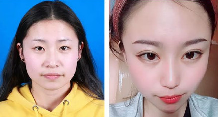 閉眼無痕雙眼皮