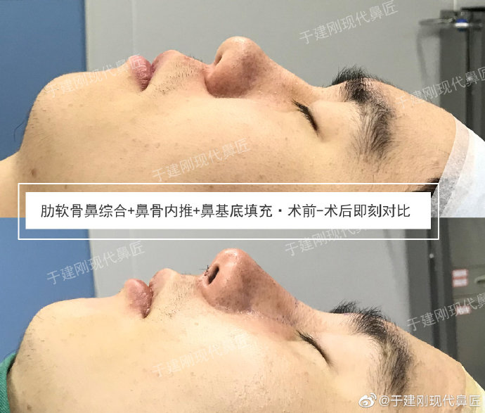 于建剛鼻綜合