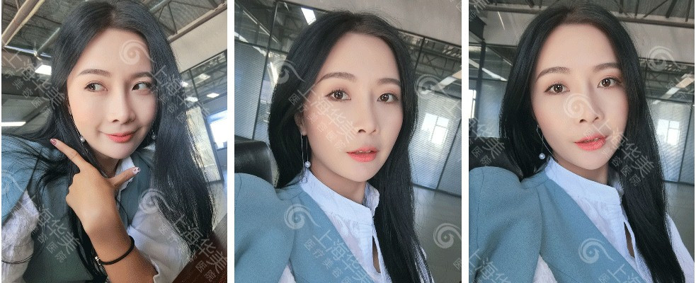 上海華美李健鼻綜合案例