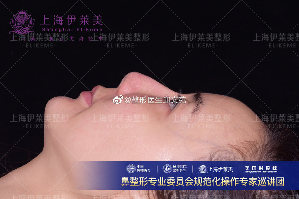 邱文苑鼻綜合案例